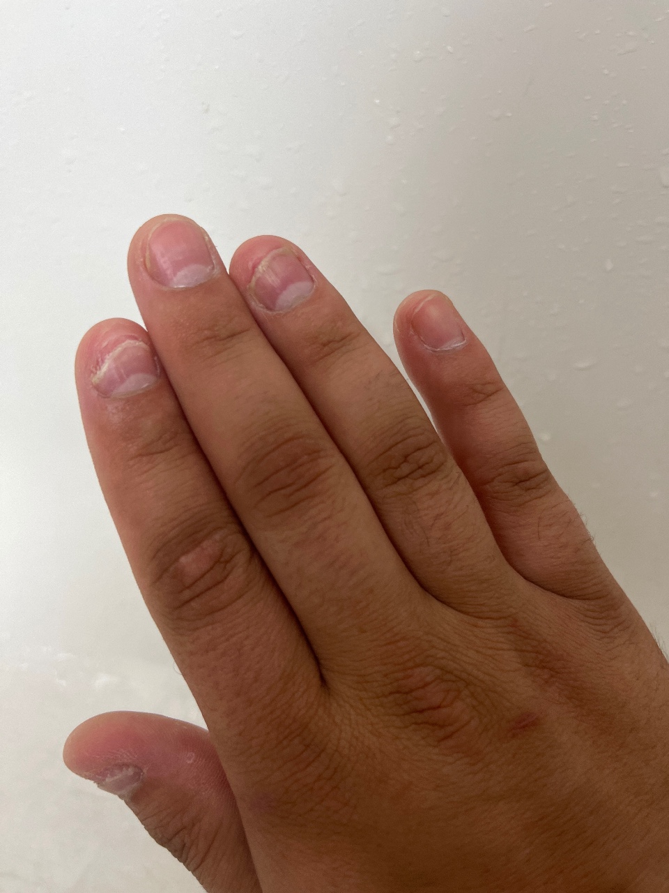 От чего слоятся ногти на руках
