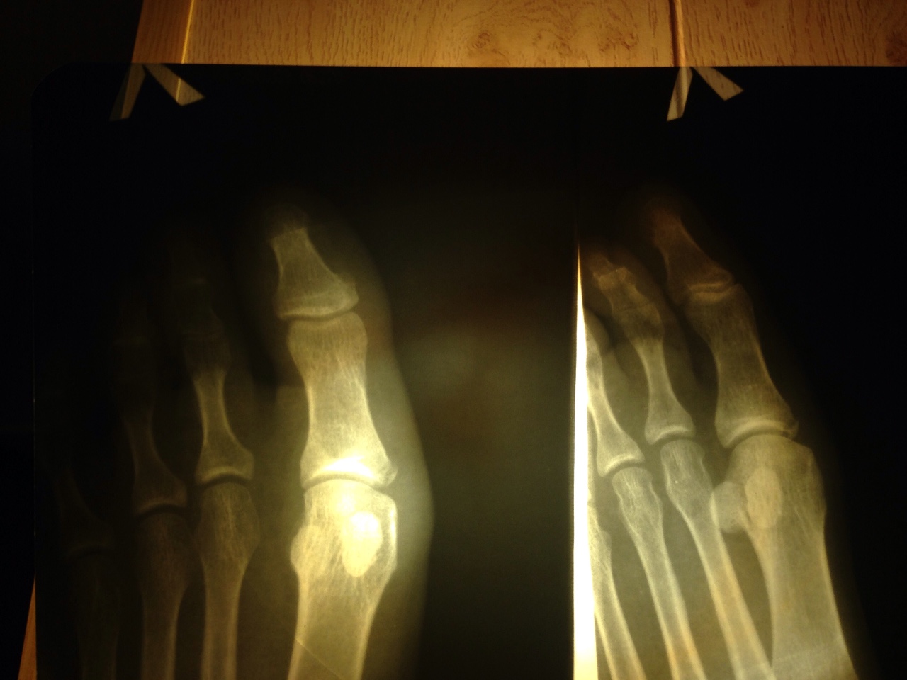 Ногтевой фаланги пальца ноги. Краевой перелом фаланги. Краевой перелом ногтевой фаланги рентген. Застарелый краевой перелом. Краевой перелом фаланги рентген.