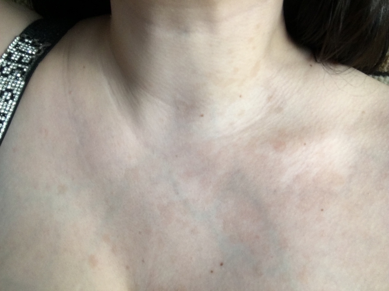 пигментация на грудях у женщин фото 33