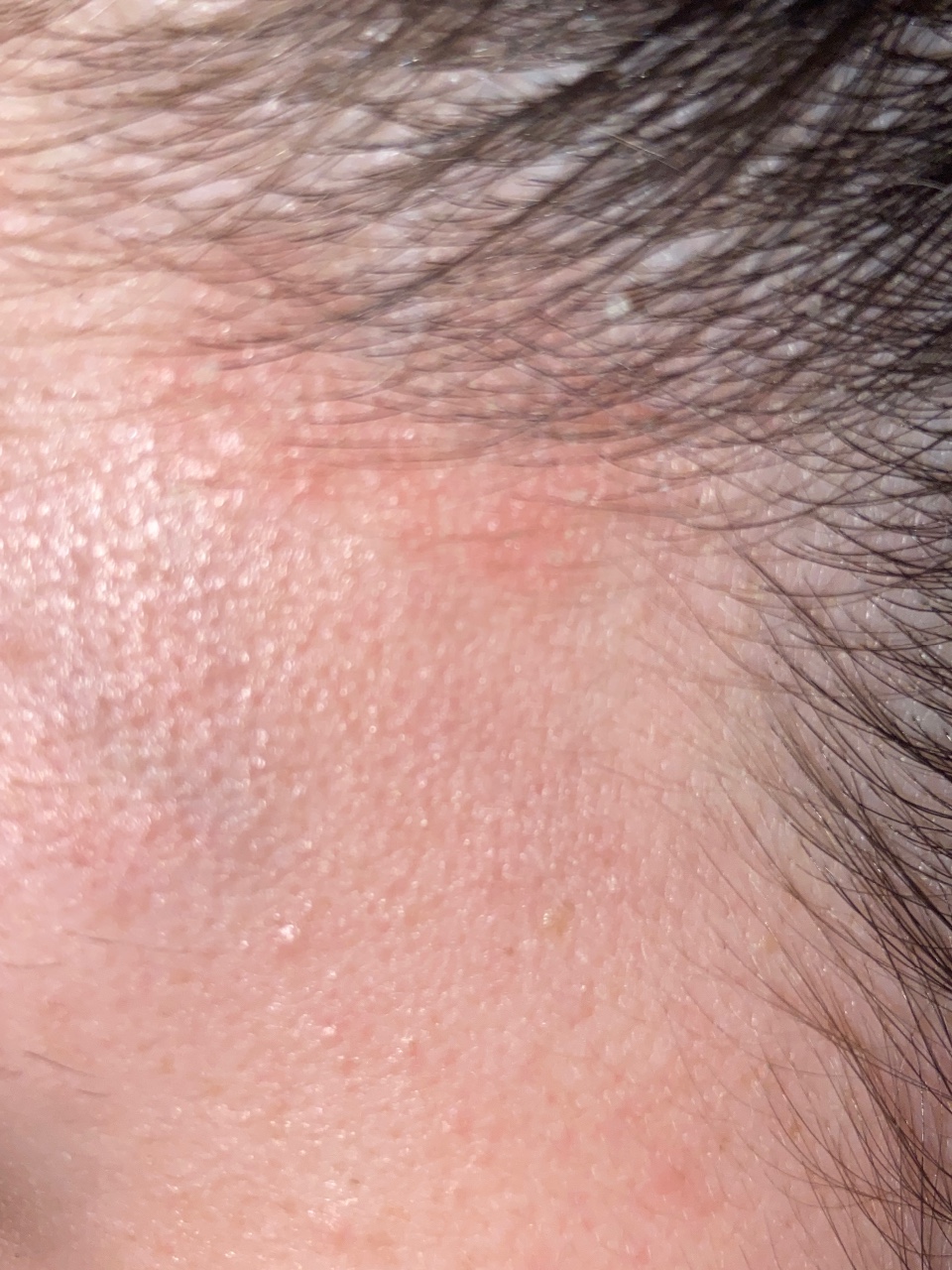 Непонятные высыпания на коже головы и теле - Вопрос дерматологу - 03 Онлайн