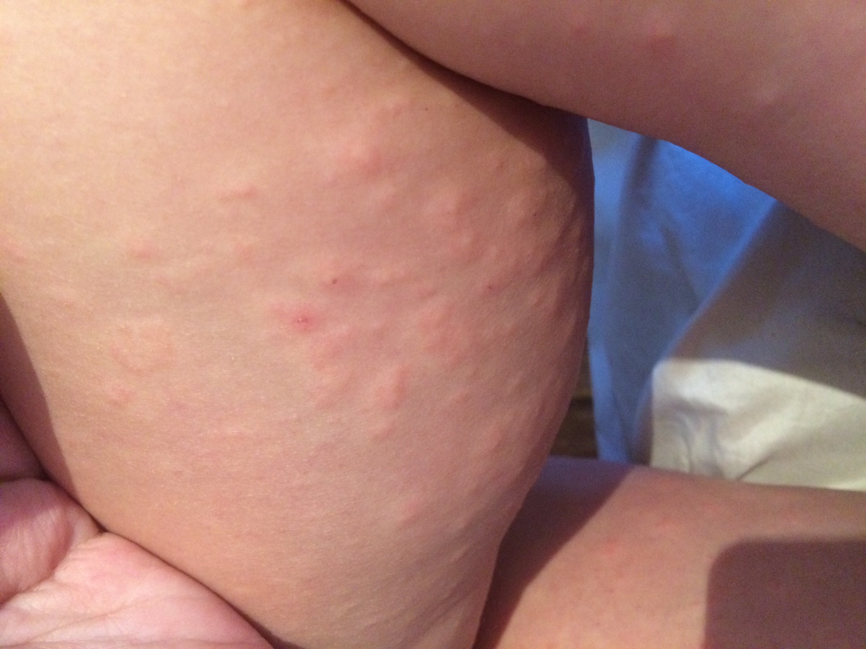 аллергия по телу по сперму фото 17