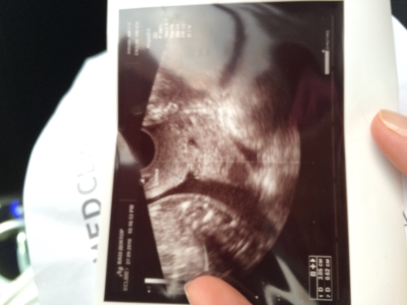 оргазм при беременности и короткая шейка матки при беременности фото 62