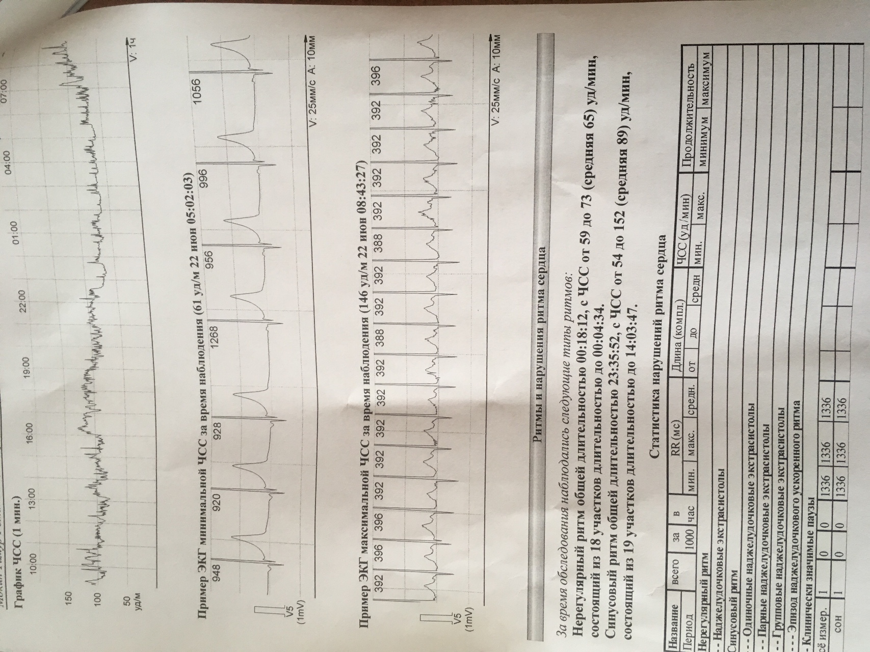 Расшифровка холтера у детей. Бланк Холтер ЭКГ. Расшифровка холтера график. Расшифровка холтера сердца.