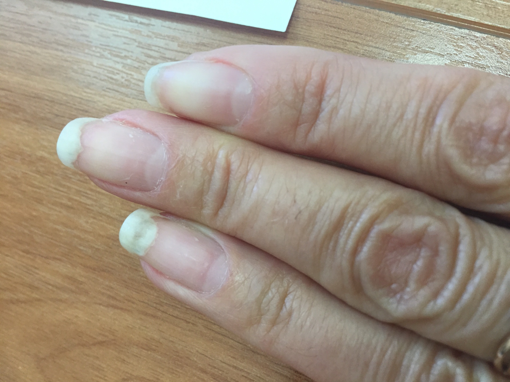 Скручиваются ногти что делать. Ониходистрофия - онихолизис.. Микотическая лейконихия. Онихолизис и белые пятна.