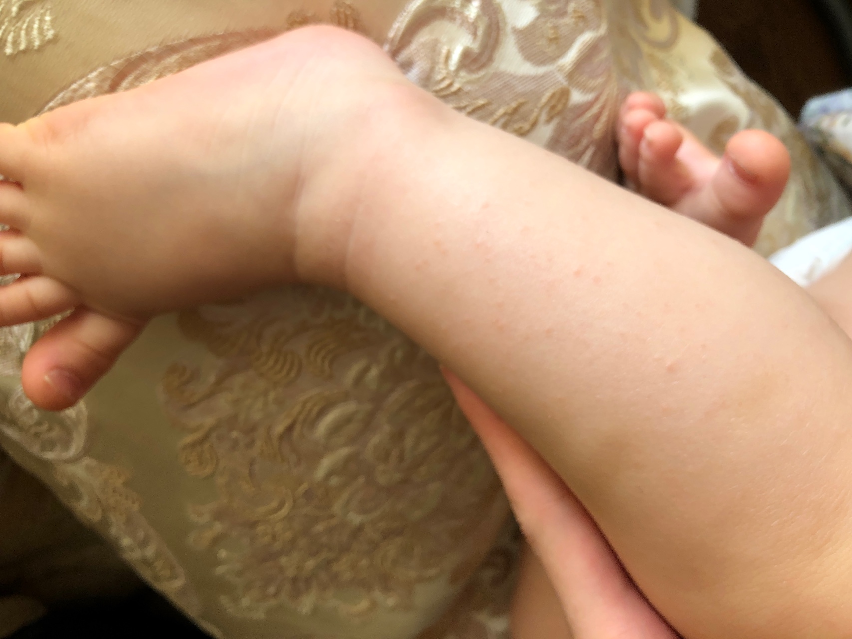 Рука нога когда у ребенка. Энтеровирусный дерматит Коксаки.