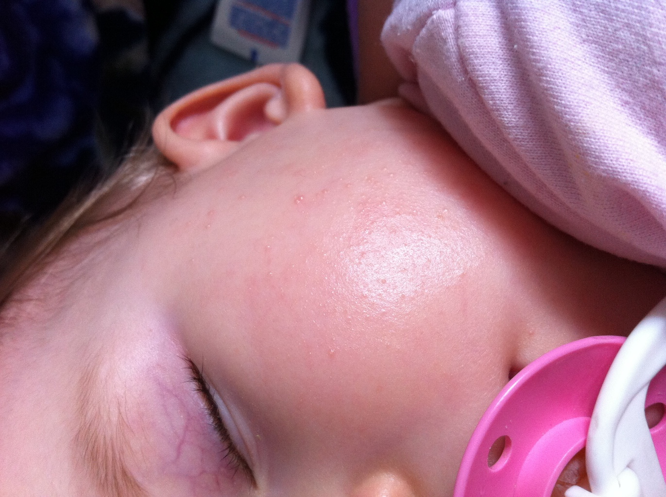 Ребенку год красные щеки. Сыпь на щеках у новорожденного. Аллергические высыпания на лице у грудничка. Аллергическая сыпь на щечках у младенца.