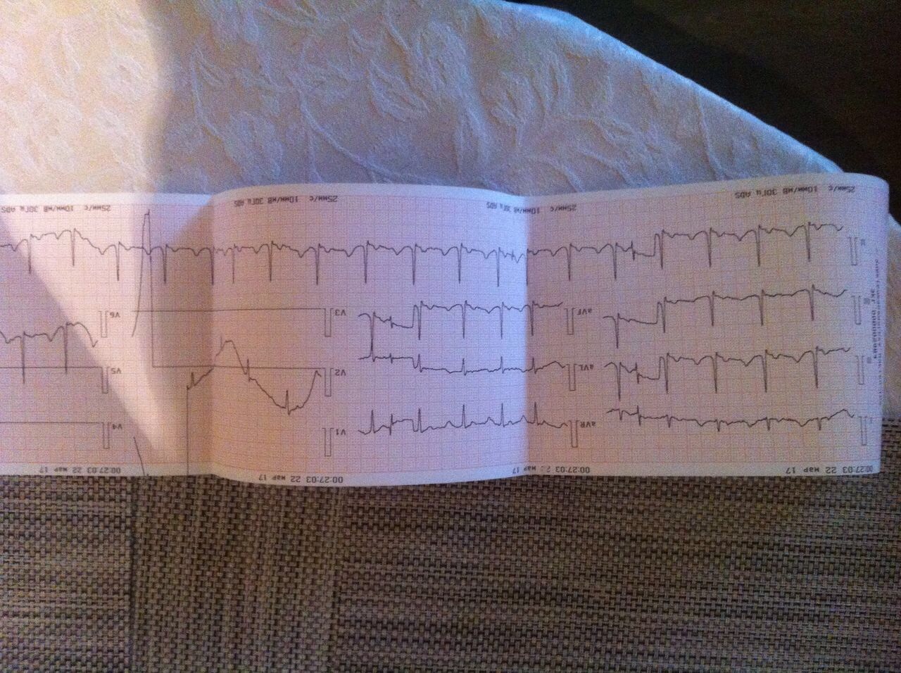 плохая кардиограмма сердца фото