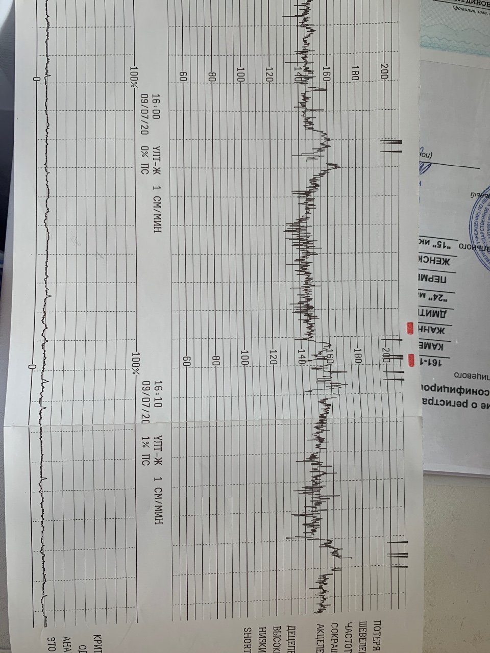 Ктг при схватках фото показатели