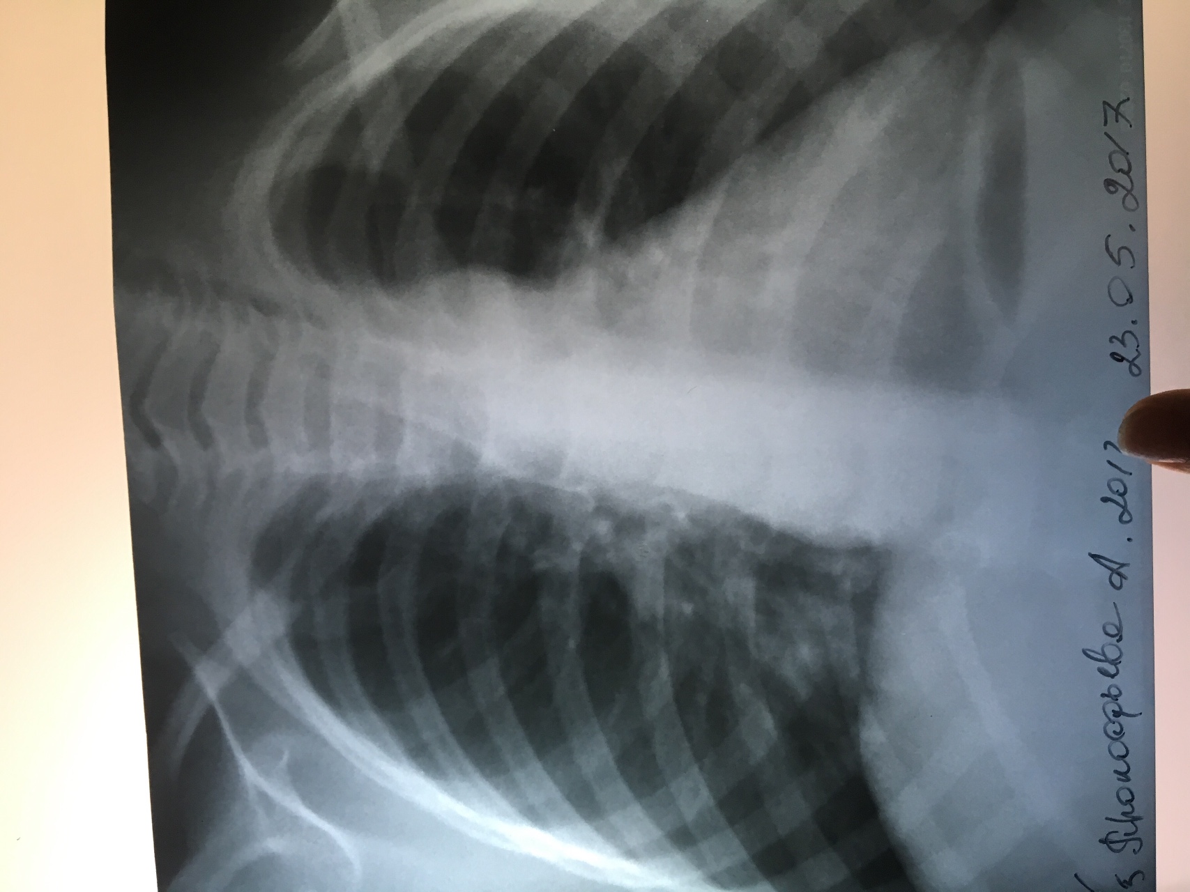 Внебольничная очаговая пневмония рентген
