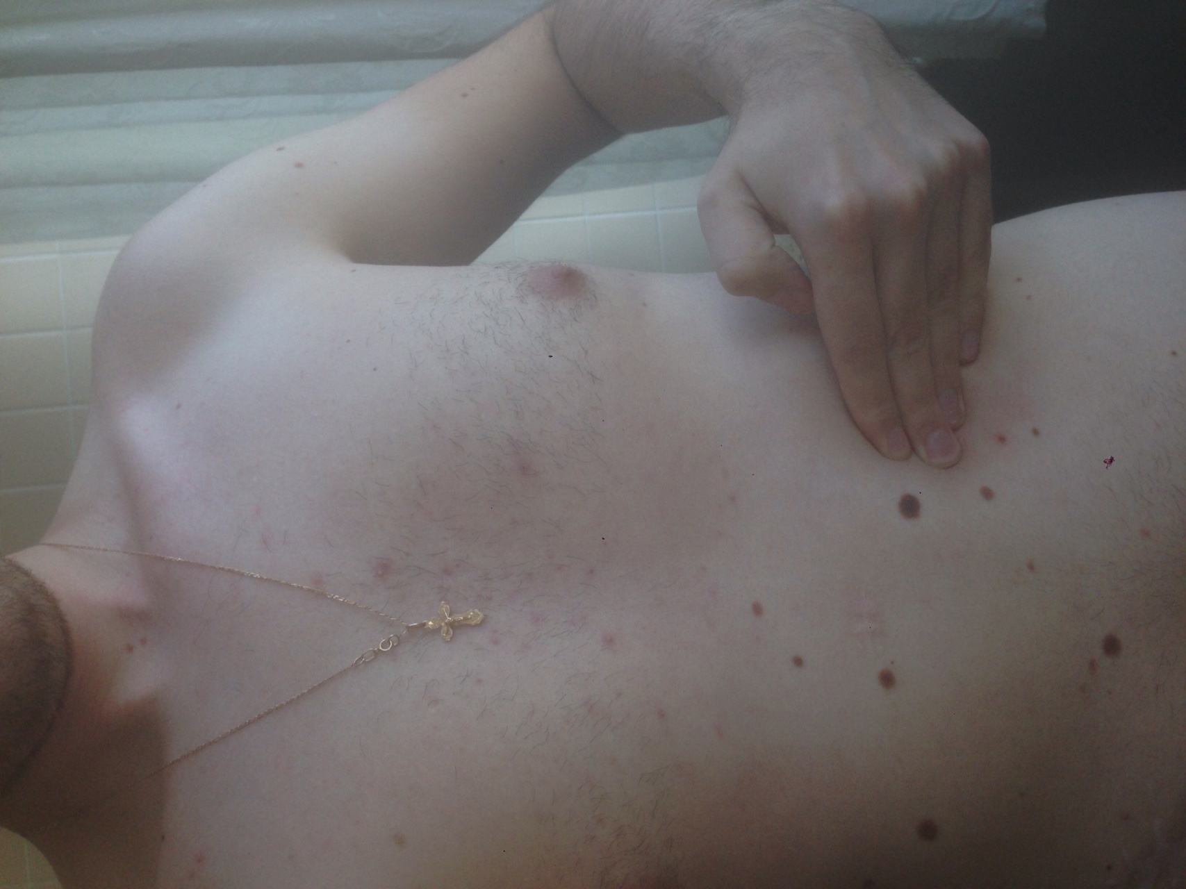 уплотнение на груди слева у мужчин фото 73