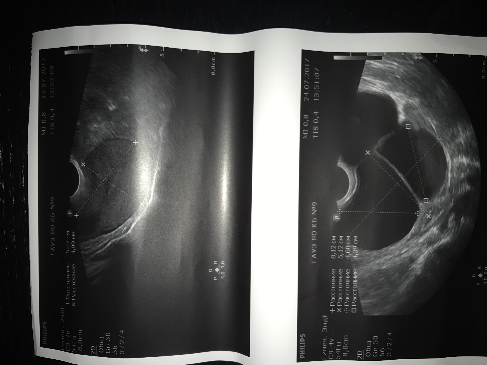 Киста 8 мм. Внематочная беременность в яичнике на УЗИ. Киста правого яичника 8 см.