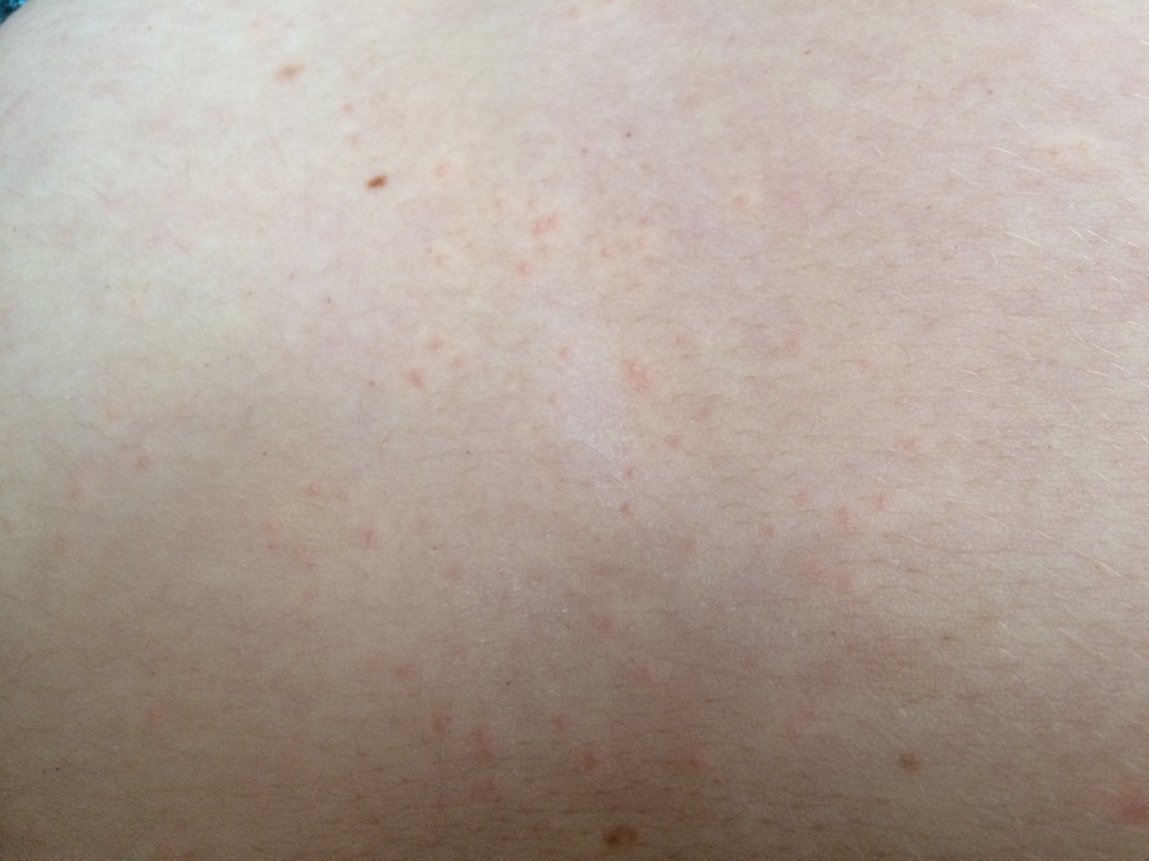 Виды аллергической сыпи на теле фото