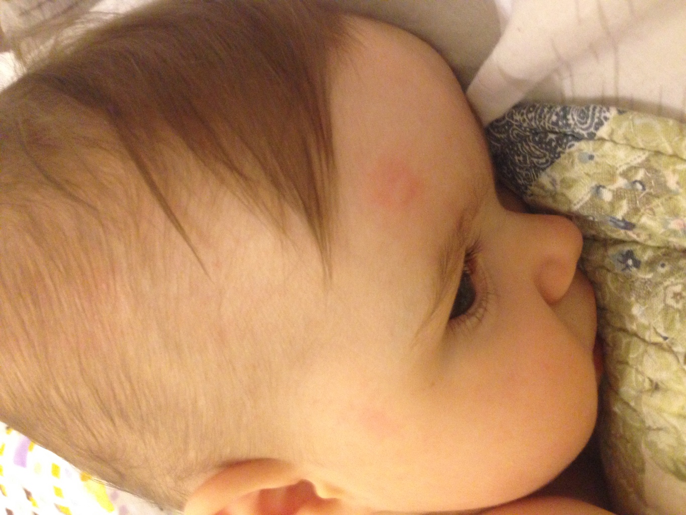 Сыпь на голове у новорожденного