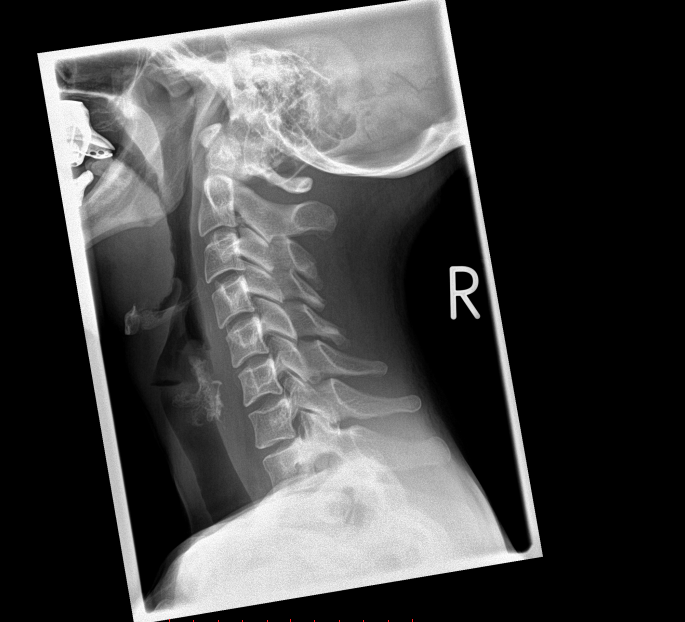 Рентген шейного отдела позвоночника. Рентген шеи здорового человека. Рентгенограмма шеи. Снимок шеи рентген.
