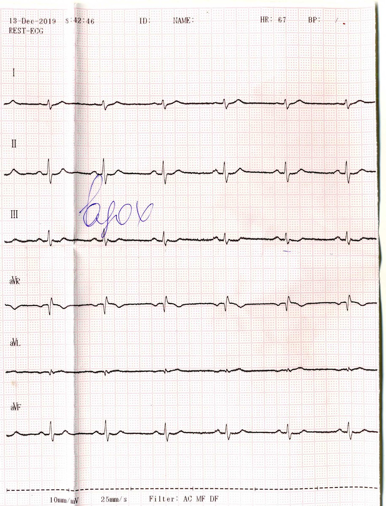 Расшифровка кардиограммы сердца по фото