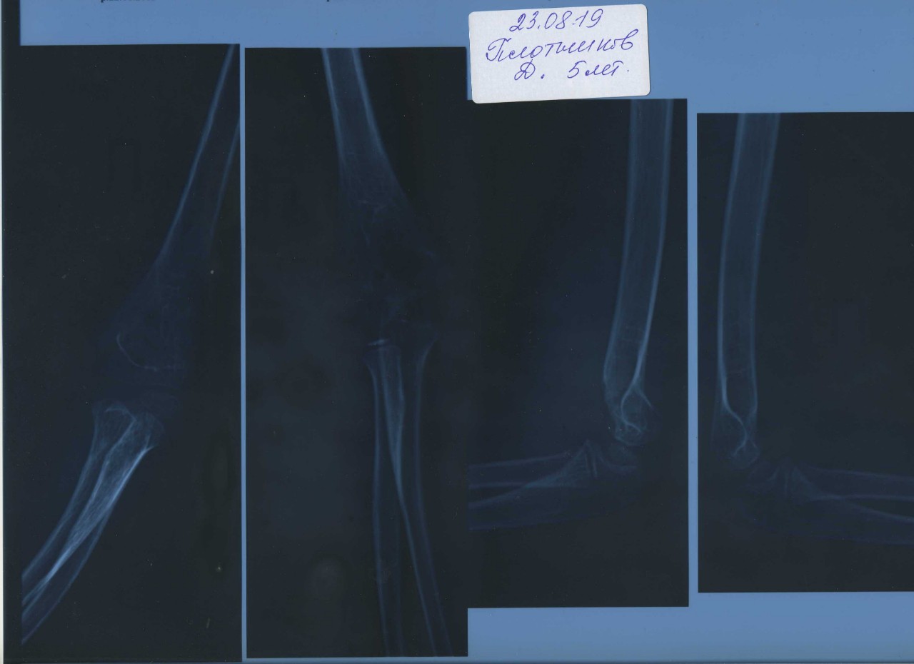 Надмыщелковый перелом плечевой кости рентген в двух проекциях