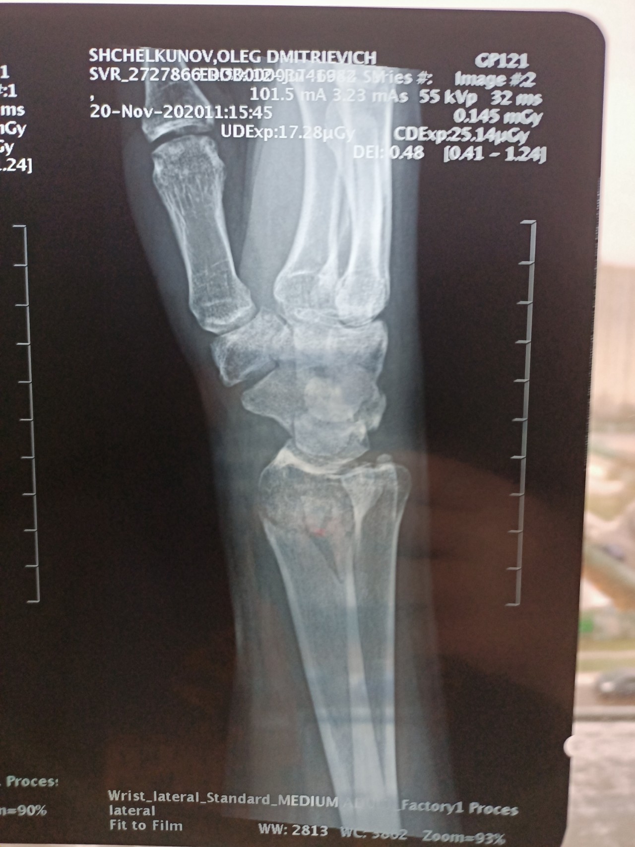 Перелом н 3. Перелом лучевых костей ноги. Лучевая кость на ноге. Пятая пястная кость стопы. Трещина лучевой кости ноги.