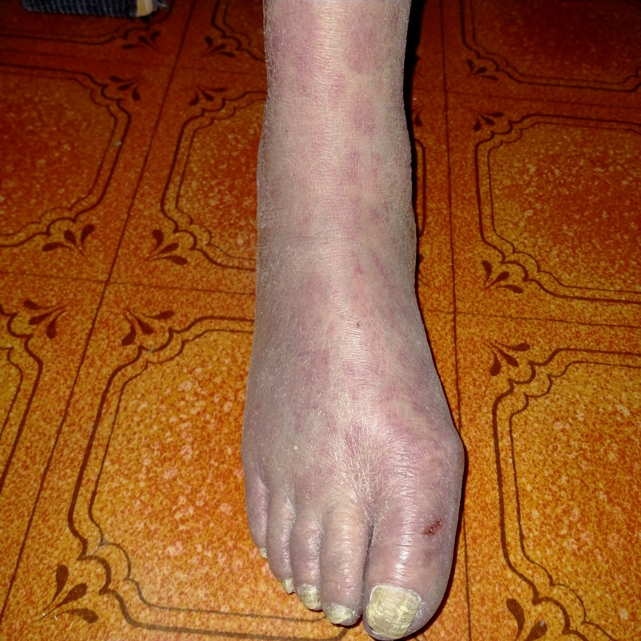 Тромбоз ног фото
