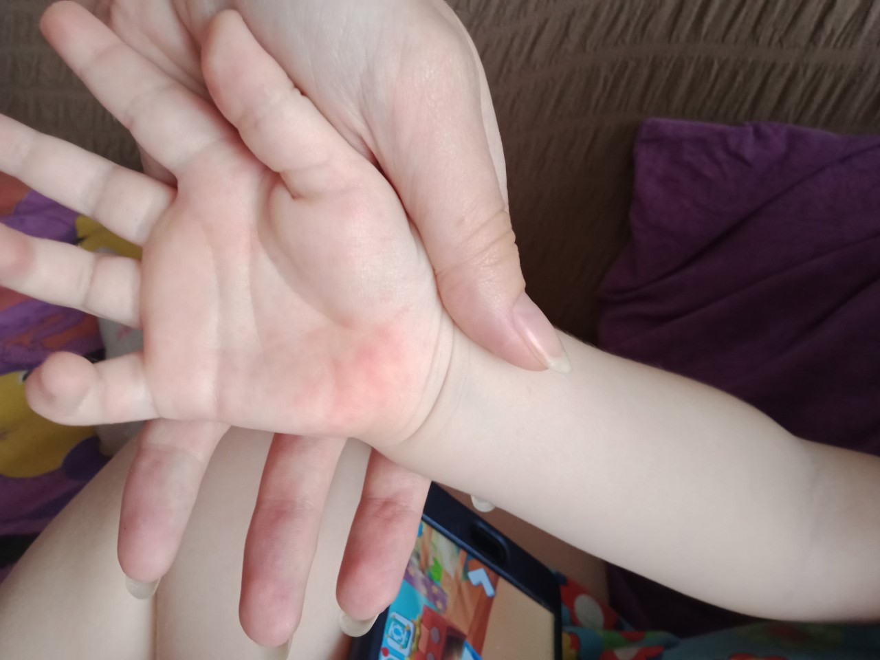 Мелкая красная сыпь на ручках у ребенка