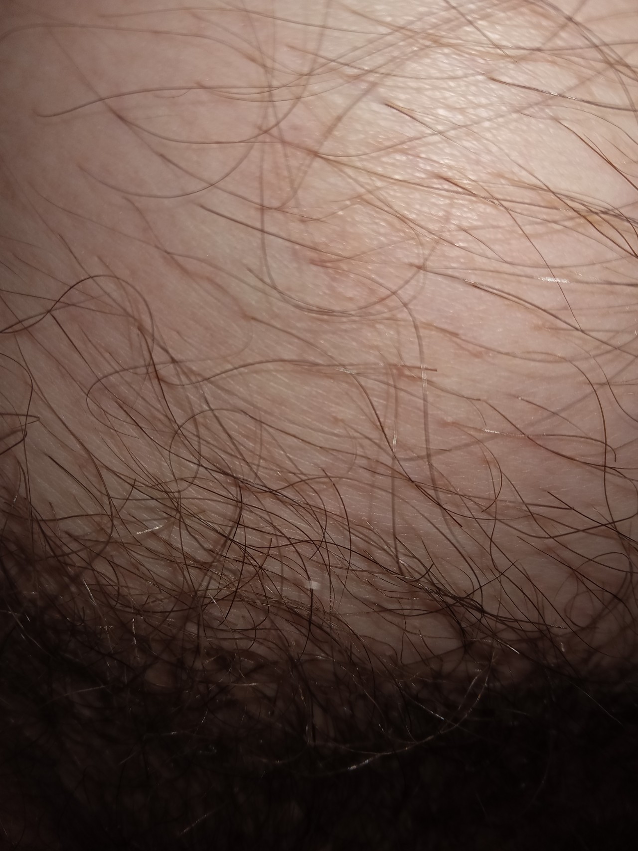 как удалить волосы на груди и животе у мужчин фото 102