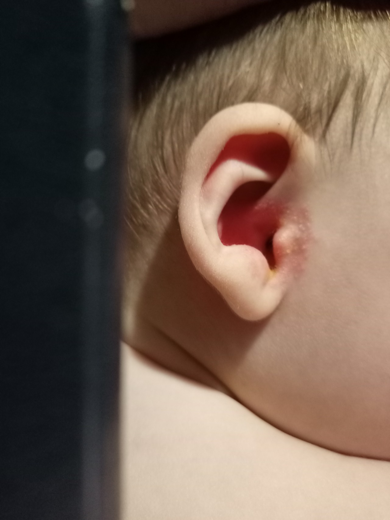 Себорейный дерматит у детей: что делать с «молочными корочками» на голове?