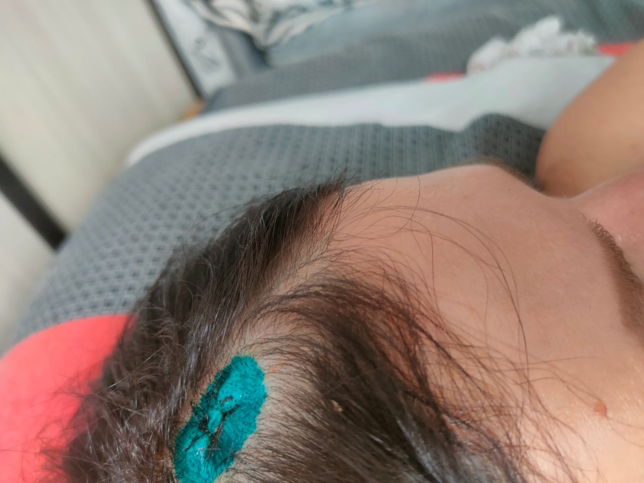 Коксаки на волосистой части головы