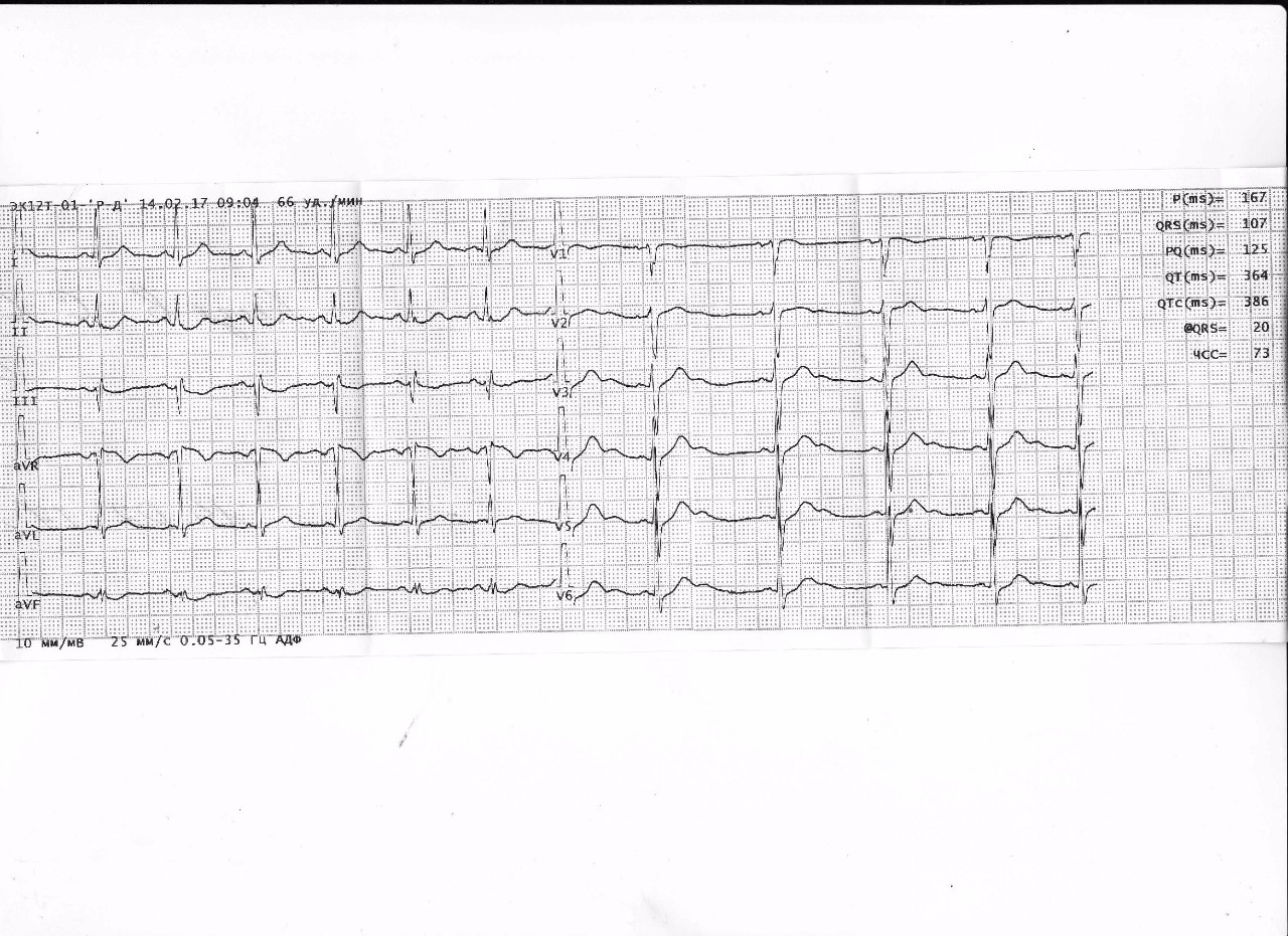 Расшифровка кардиограммы сердца по фото