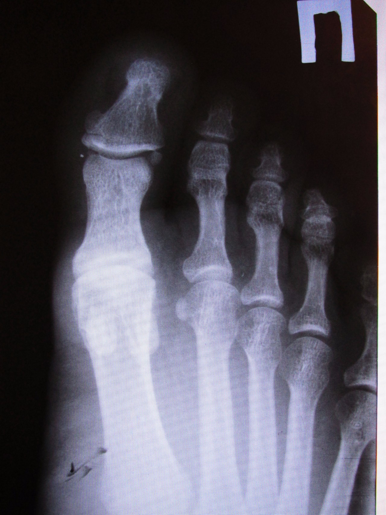 Перелом основной фаланги 1 пальца стопы рентген