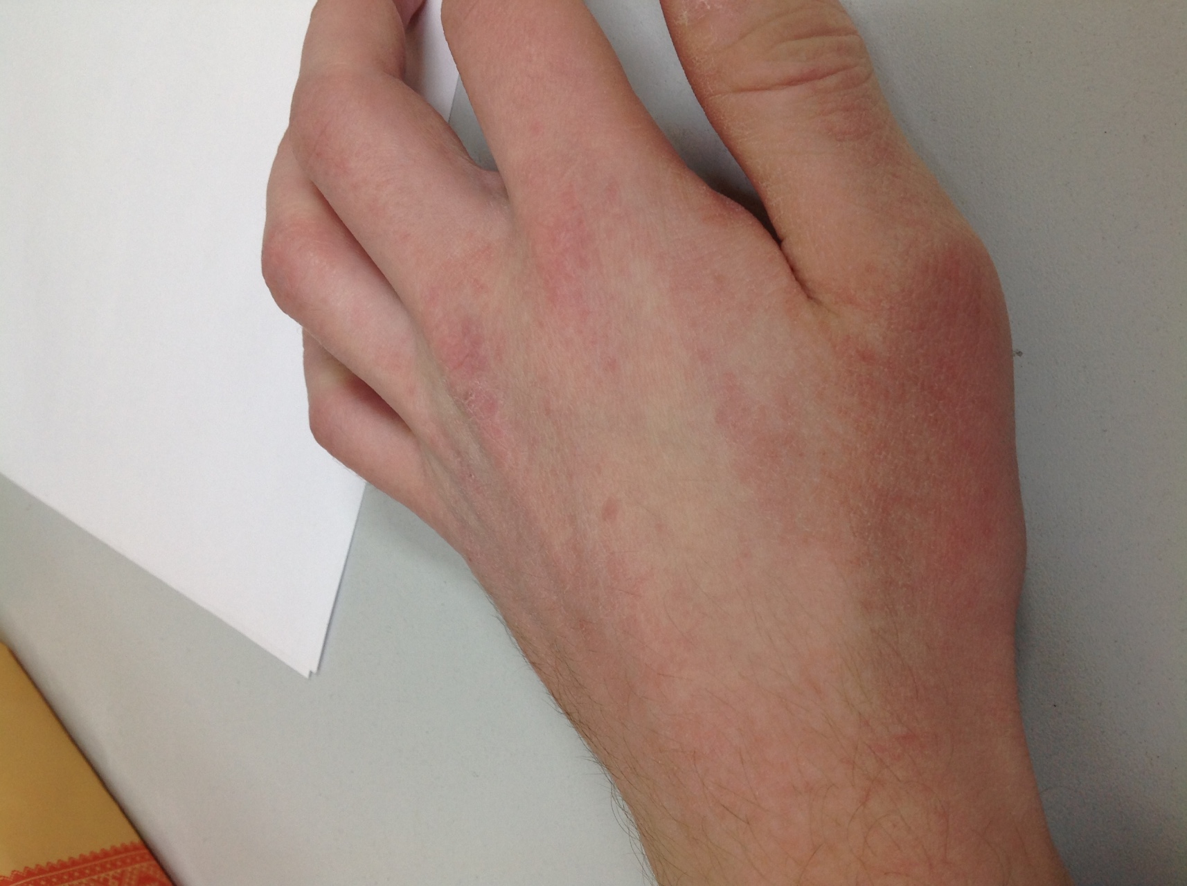 Контактный дерматит на пальцах рук фото