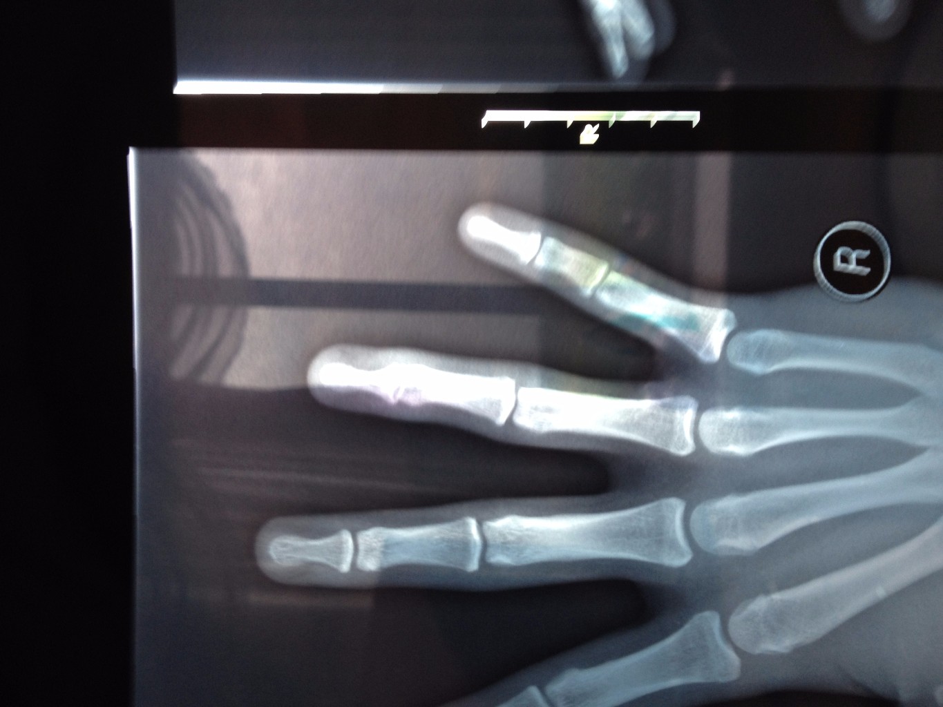 Перелом фаланги мкб 10. Краевой перелом ногтевой фаланги. Краевой перелом фаланги пальца рентген.