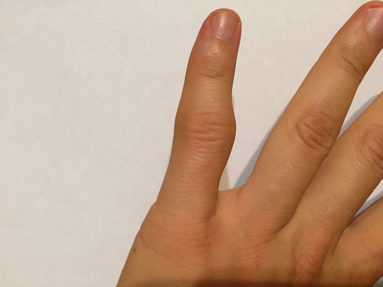 На рост на пальце руки. Перелом второй фаланги безымянного пальца. Перелом указательного пальца.