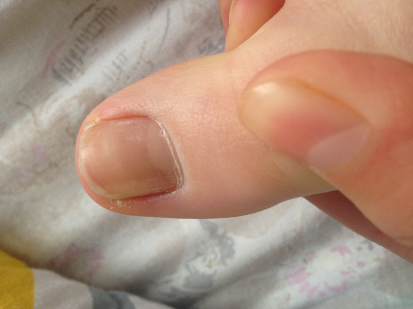 грибок ногтей начальный фото