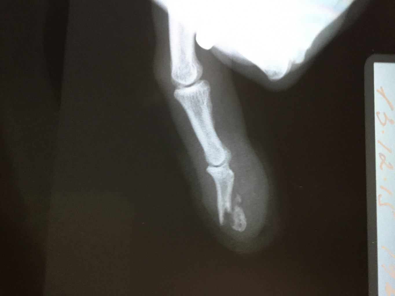 Открытый перелом фаланги. Открытый перелом мизинца. Наружный перелом пальца. Перелом мизинца на ноге рентген.