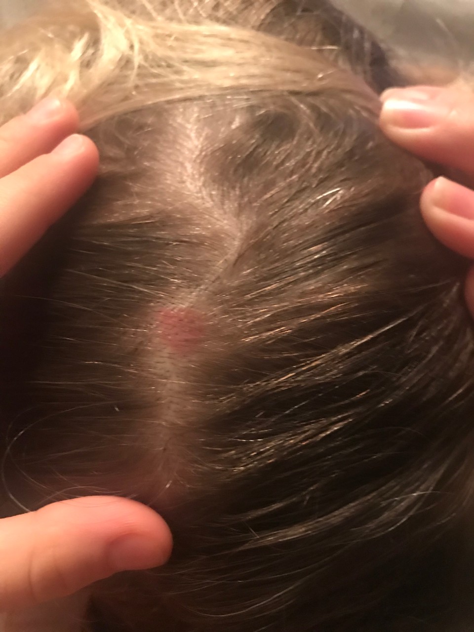 фото заболевания волосистой части головы у виска