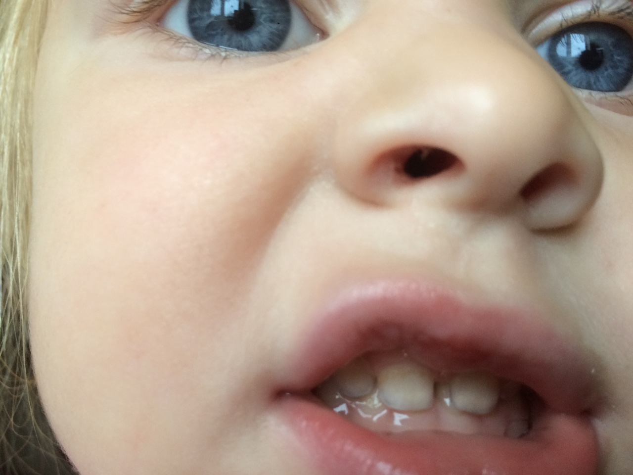пятна на зубах у ребенка фото