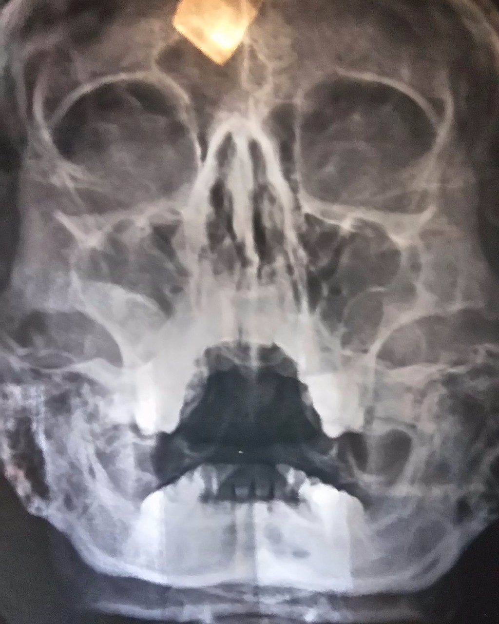 Гайморит пазухи. Верхнечелюстной синусит рентген. Рентген околоносовых пазух синусит. Рентген пазух носа фронтит.