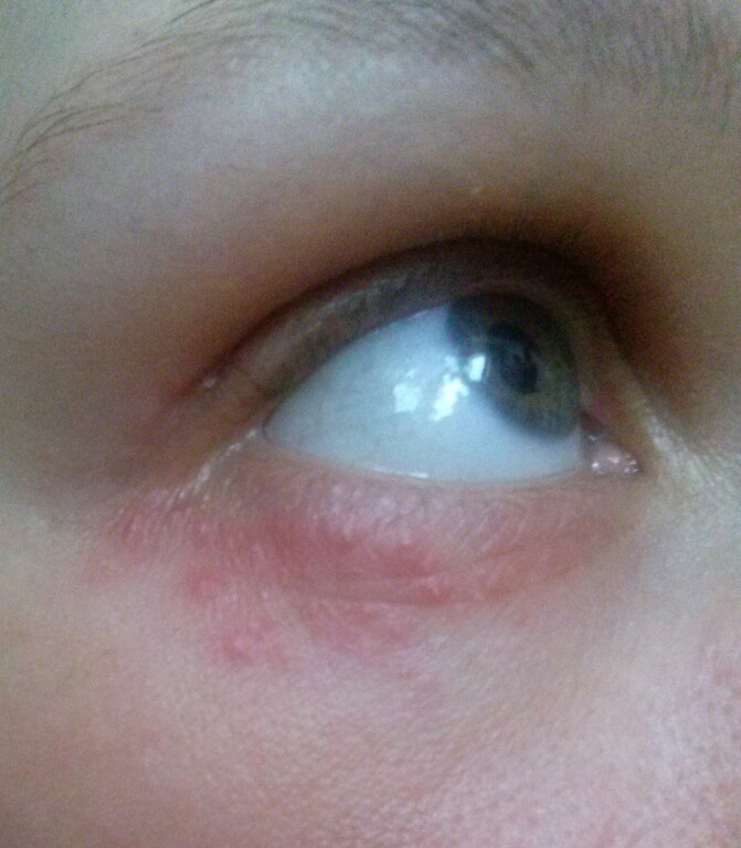 Что вызывает аллергию на глазах
