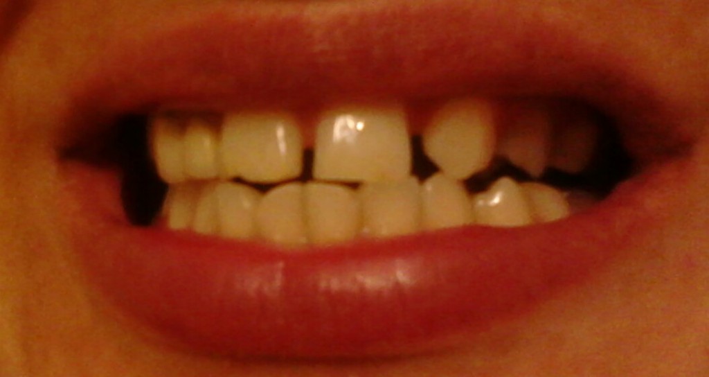 Какое расстояние между зубами. Большой промежуток между передними зубами. Тремы - промежутки между зубами.. Дети с большим расстоянием между передними зубами.