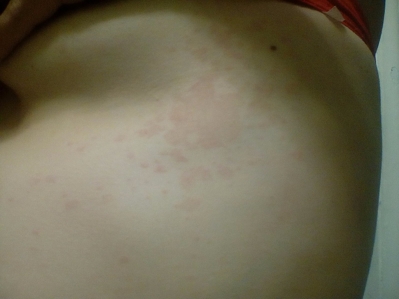 аллергия на груди у беременной фото 27