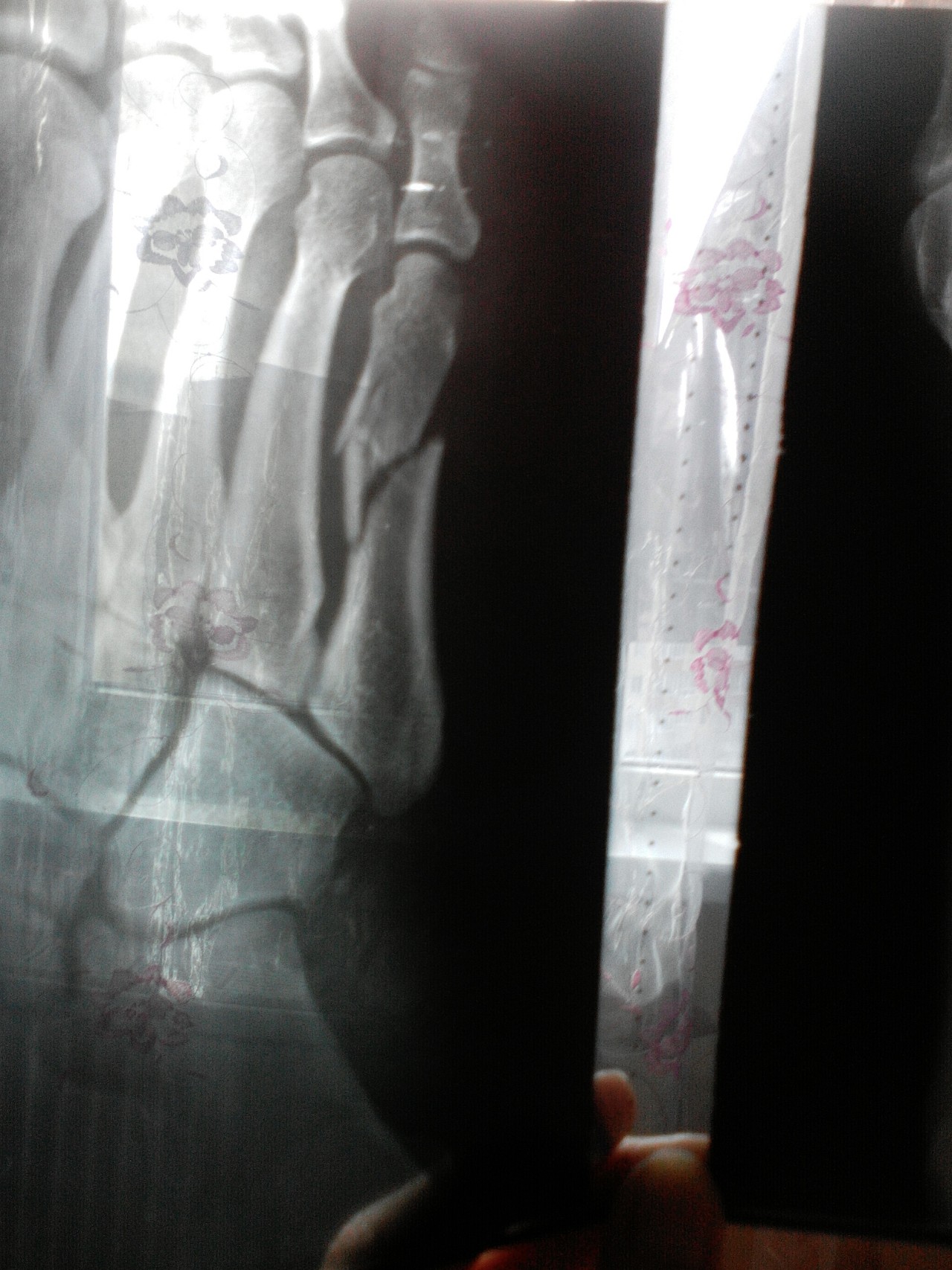 Перелом 5 плюсневой кости стопы без смещения фото до и после