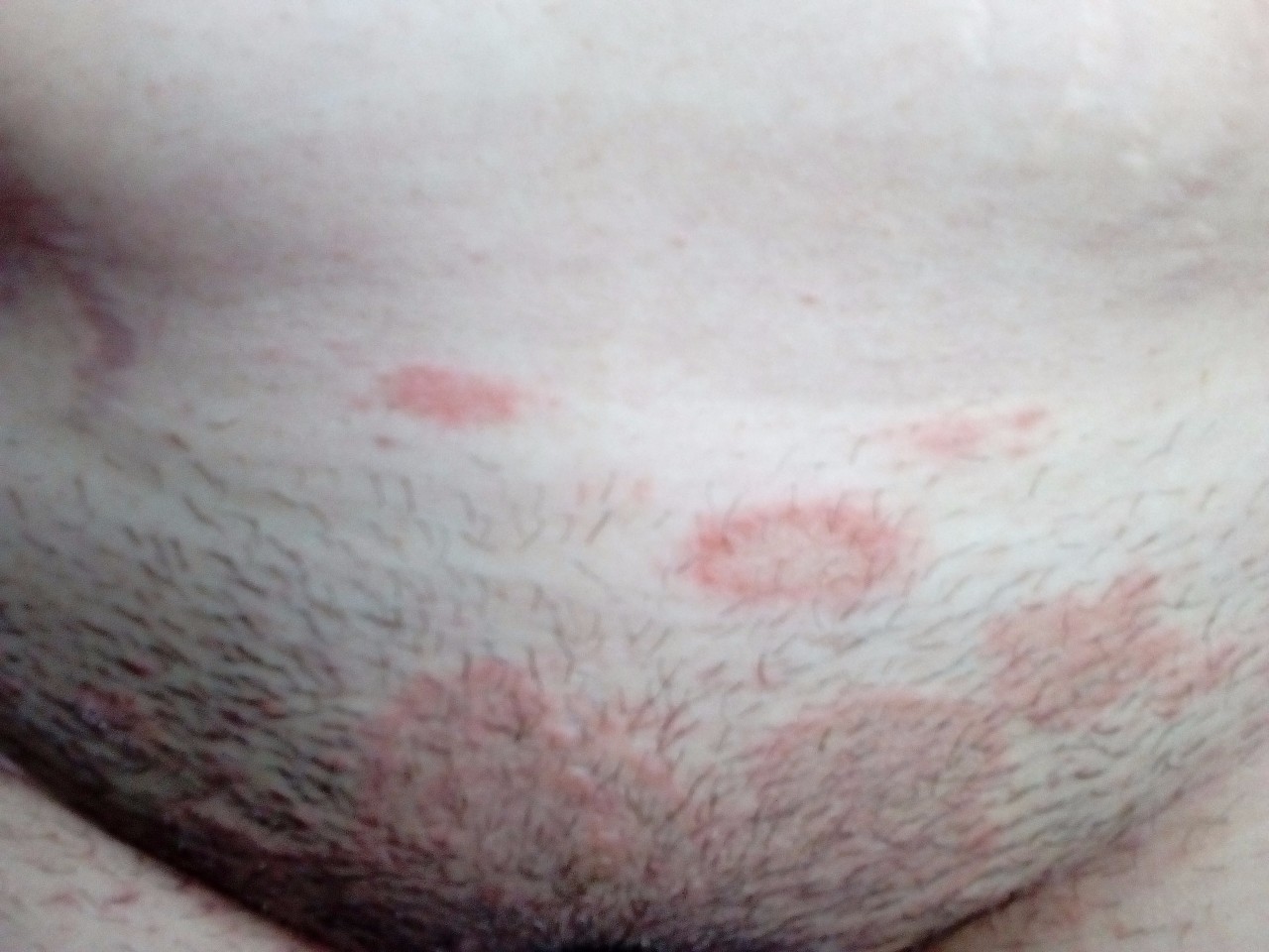 покраснение кожи груди мужчин фото 43