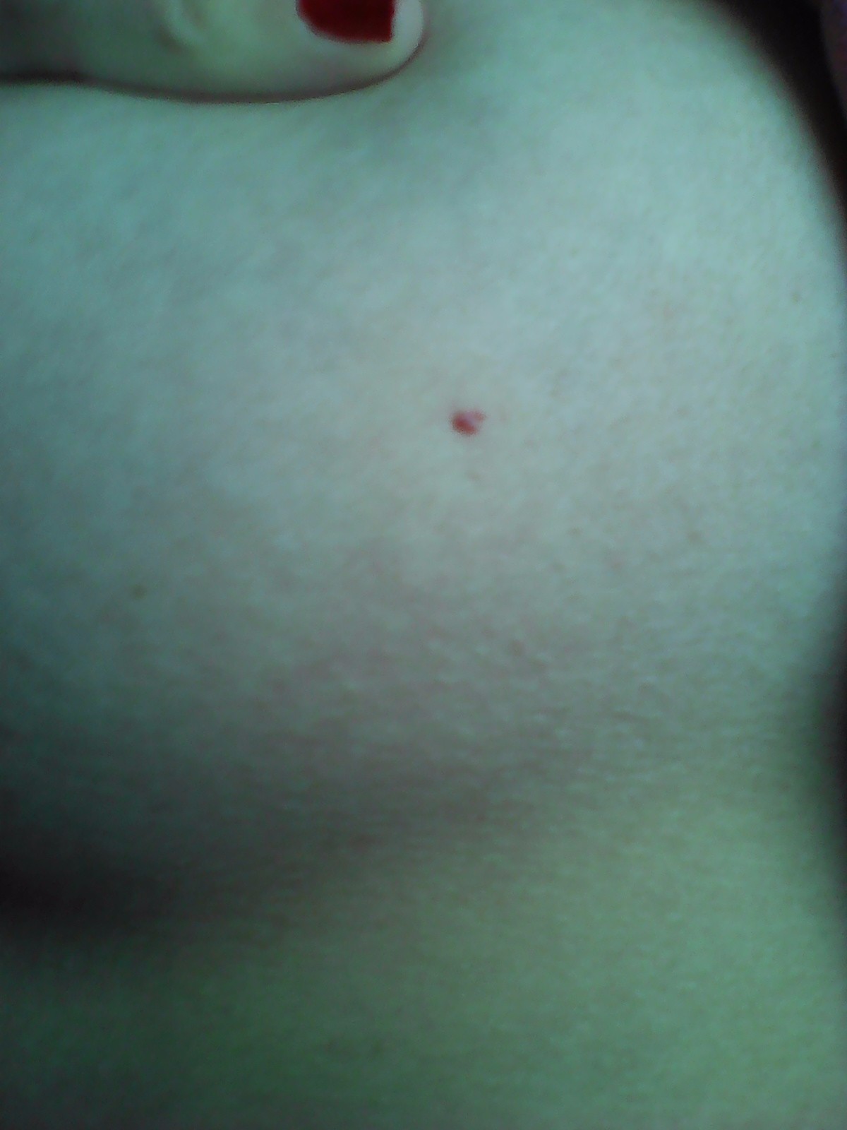 красные точки на груди у женщин фото 12