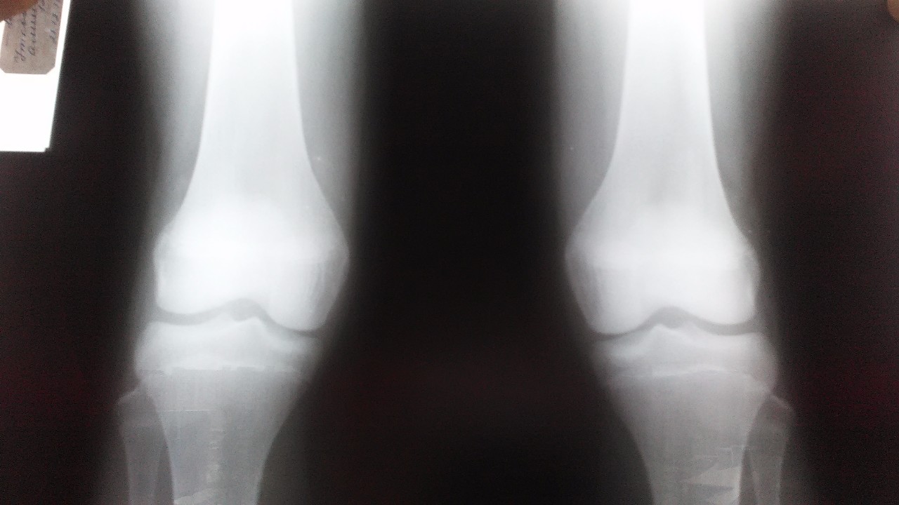 Артропатия код. Ревматоидный артрит рентген колени. Реактивный артрит коленного сустава. Ревматоидный артрит коленного сустава у ребенка на рентгене. Реактивный артрит коленного сустава рентген.