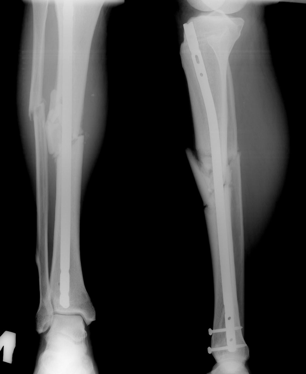 Перелом ноги название кости