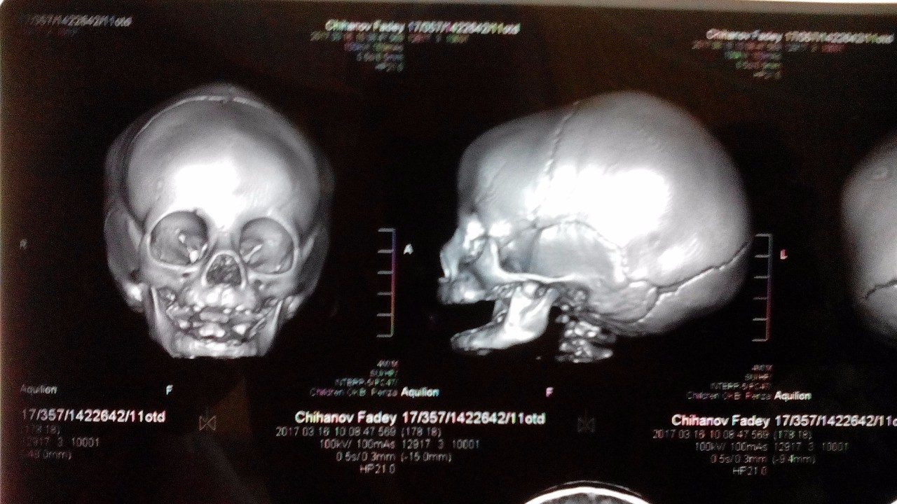 Краниостеноз у детей фото