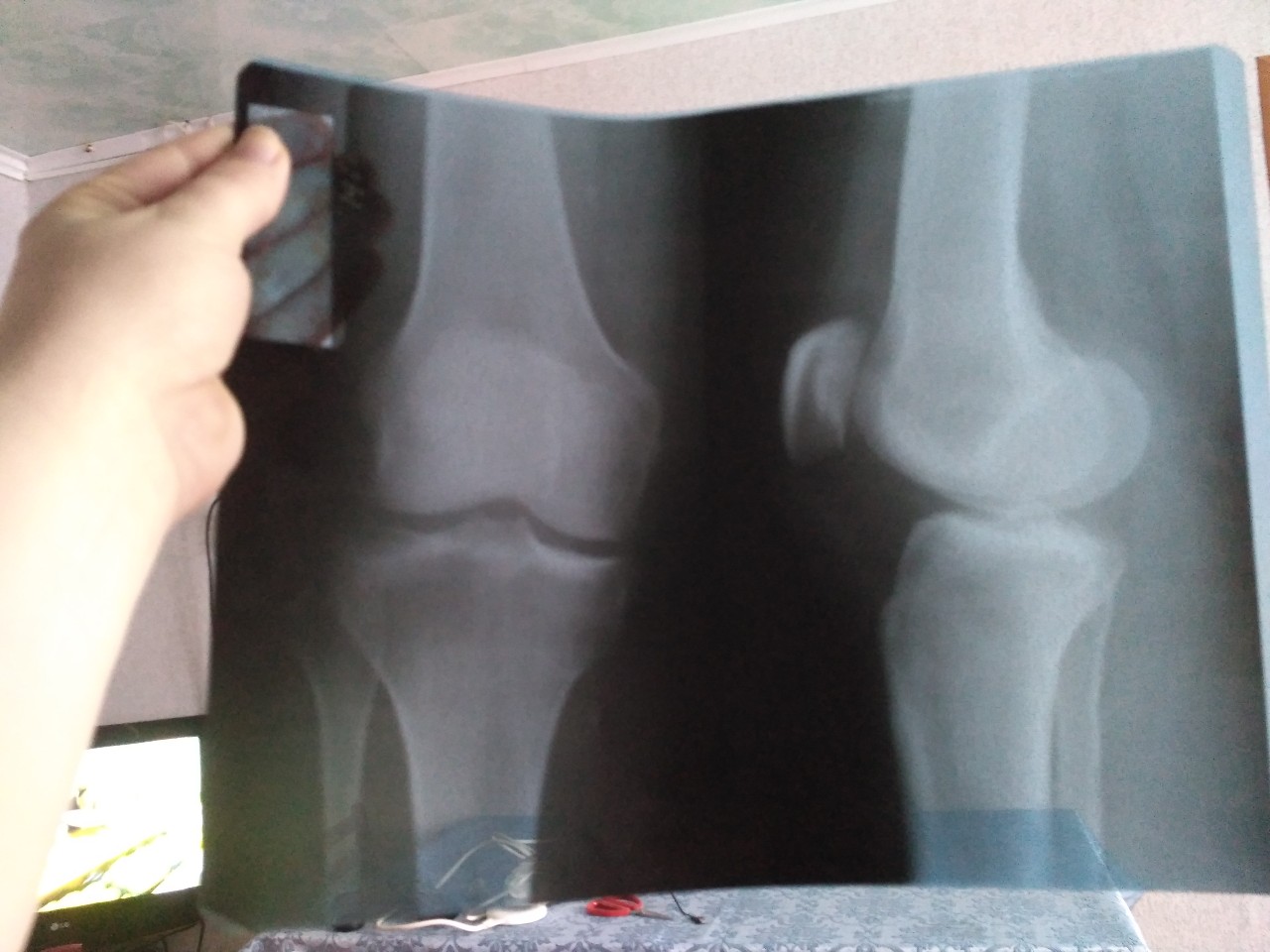 Трещина в суставе. Перелом чашечки коленного сустава рентген. Смещение чашечки коленного сустава рентген. Перелом коленной чашечки рентген. Перелом коленного сустава рентген.