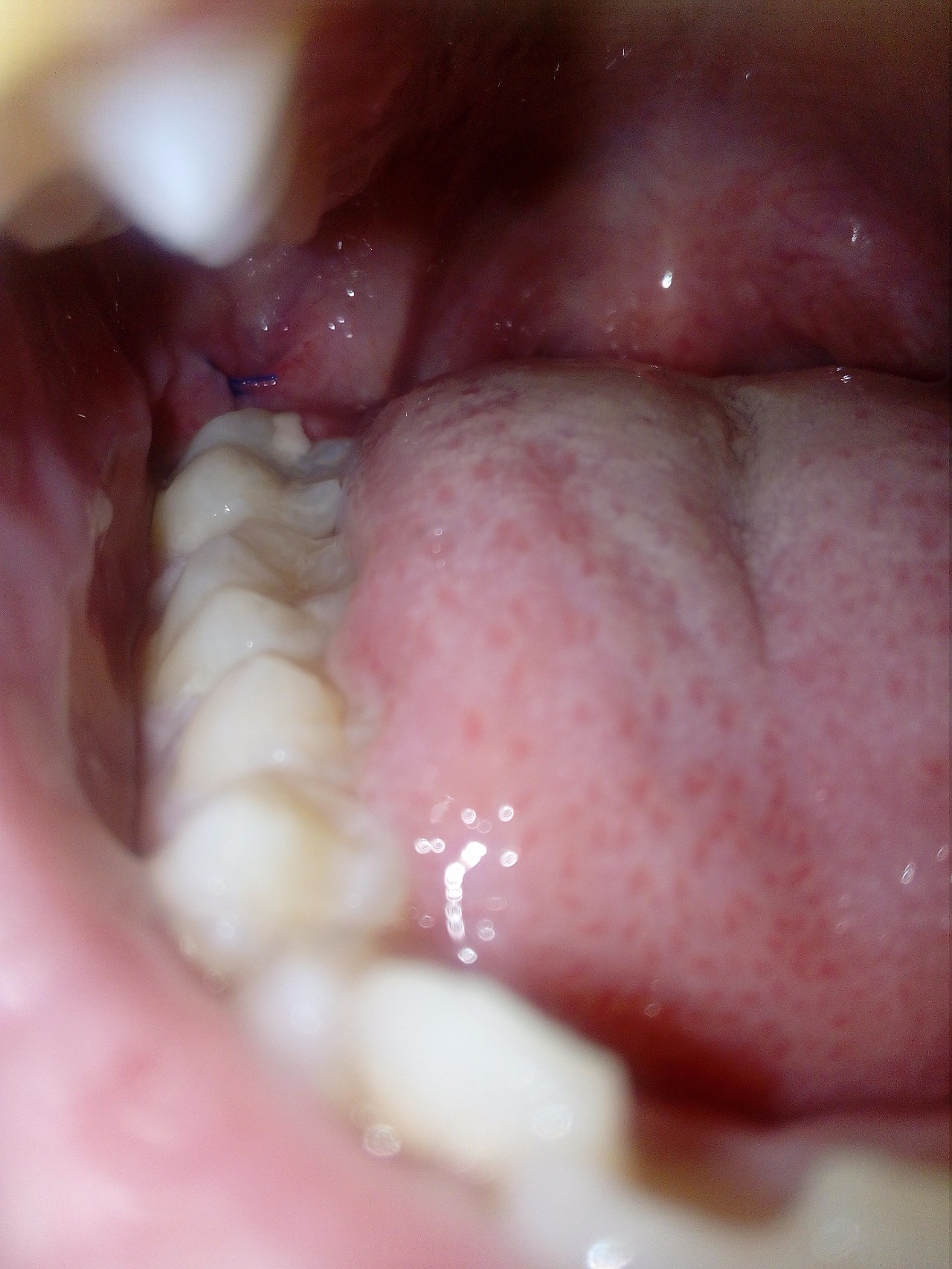 Хирургическая стоматология: удаление зубов мудрости