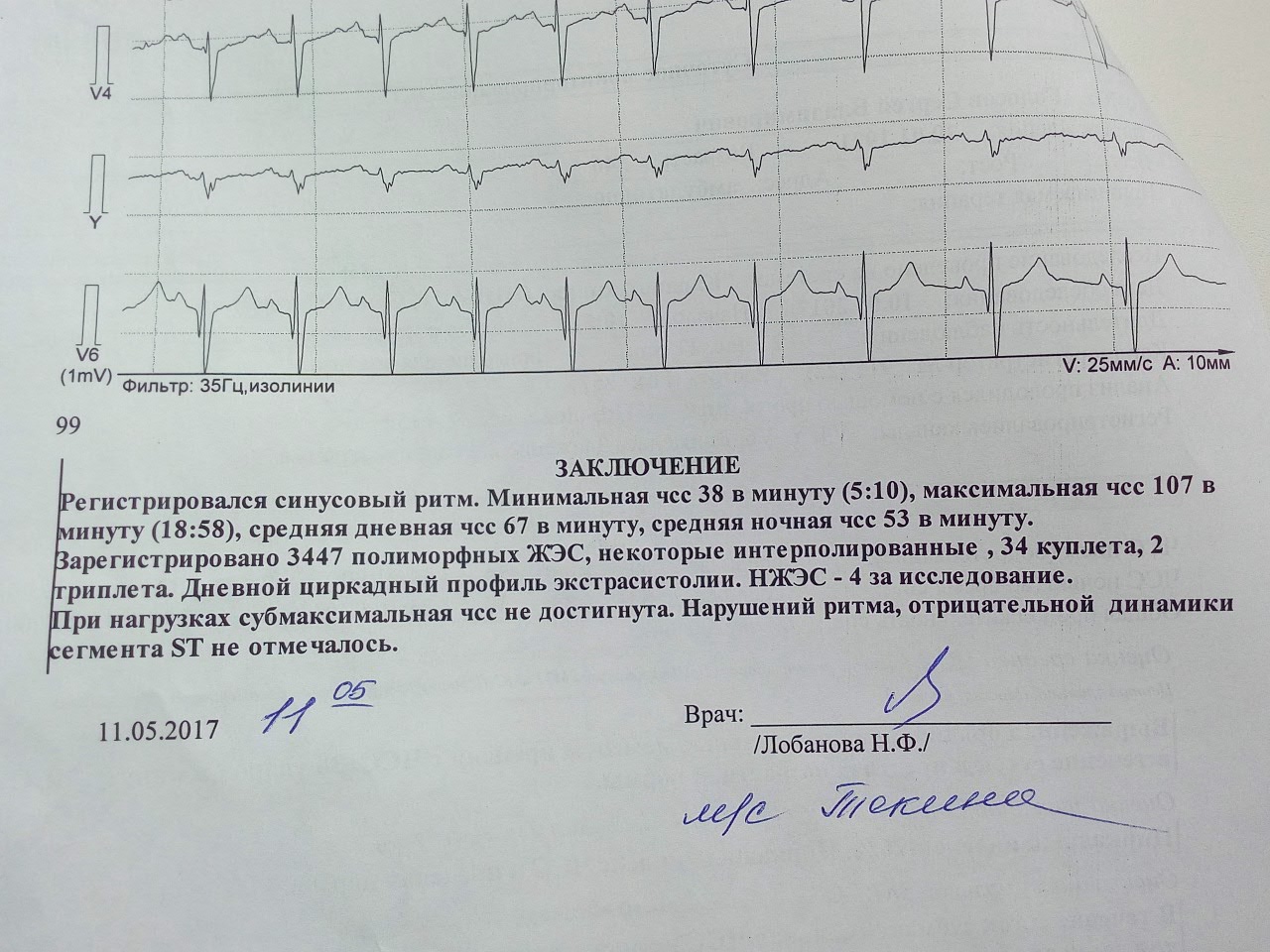 Экг описание норма образец