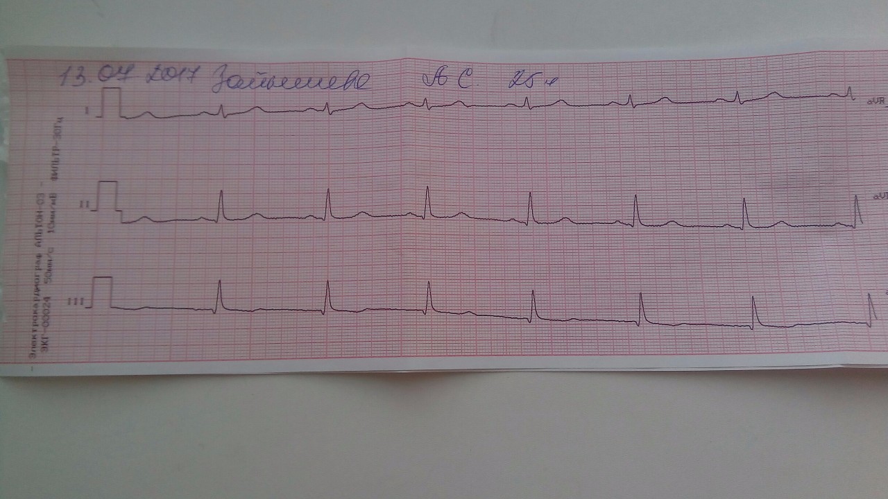 Плохая кардиограмма сердца у взрослого фото