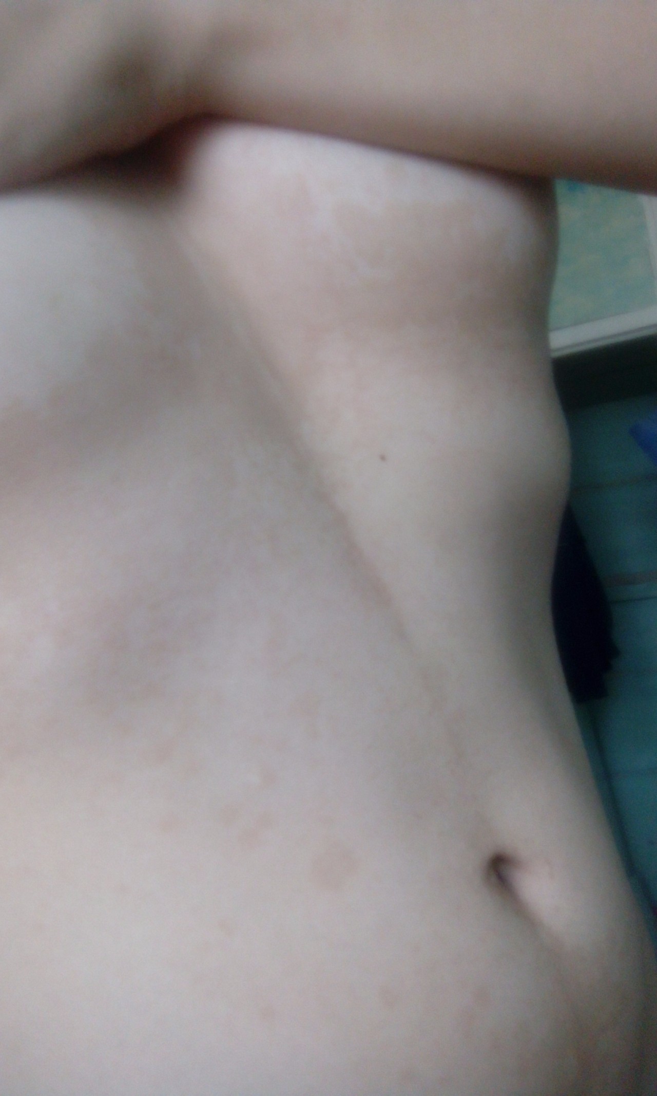 красные высыпания на груди у женщин фото 74